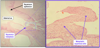 The replacement may sometimes be incomplete with persistence of… Histoquarterly Cervix Histology Blog