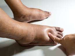 Simak ulasan di bawah ini untuk mengetahui apabila sakit lutut tidak kunjung sembuh, terasa panas, dan nyeri luar biasa segera periksakan ke dokter. Kaki Bengkak Penyebab Obat Dan Cara Mengatasinya