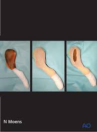 Patient in lateral recumbent position on right or left side, pillow for head elbows flexed, arms up, knees and hips partially flexed, pillow between knees to maintain a lateral position align midcoronal plane with cr and midline of table. Lateral Recumbency Position