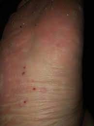 Was Ist Das Am Fuss Diese Rote Stellen Haut Fusse