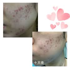 十日 十日就可以見到發炎既情況減少左 暗瘡係長期戰爭 幸好客人願意配合我哋嘅產品使用每一個步驟都跟得好足所以進展好好 網上訂購 w print tattoos paw print paw print tattoo
