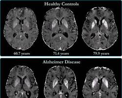 รูปภาพAlzheimer's disease brain scan