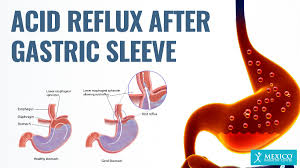 Reflux After Laparoscopic Sleeve Gastrectomy