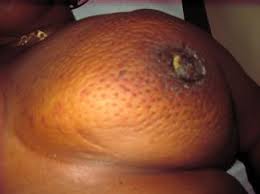 Inflammatory breast cancer usually starts with the reddening and swelling of the breast instead of a distinct lump. Inflammatory Breast Cancer Symptoms Treatment And Outlook