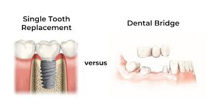 Dental Implants In Brandon Fl Advanced Dental Care Brandon
