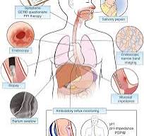 Assessing Old and New Diagnostic Tests for Gastroesophageal ...