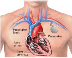 The primary function of the pacemaker is to restore a more regular beat when the heart cannot maintain a normal heart rate. 5 Personal Implants And Medical Devices Airport Passenger Screening Using Millimeter Wave Machines Compliance With Guidelines The National Academies Press