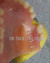We did not find results for: Klinik Gigi Pakar Evercare Kajang Gigi Palsu Patah Kami Repair Kami Juga Buat Baru Evercare Dental 0199599500 Gigipalsupatah Denture Brokendenture Cheap Facebook