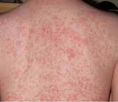 Demam denggi terdiri daripada demam denggi biasa dan demam denggi berdarah yang boleh membawa kepada kematian. Demam Denggi Aida Vitamin