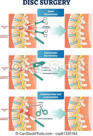 Buy back bone on alibaba.com at unbeatable offers and enjoy the outcomes. Disc Surgery Vector Illustration Diagram With Back Nerves And Bones Pain Disc Surgery Vector Illustration Medical Labeled Canstock