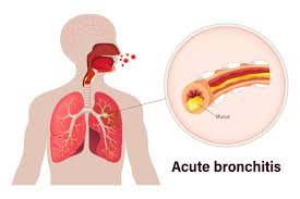 Image result for Acute Bronchitis