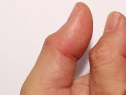 Tentu saja, karena bagian nyeri pada pergelangan tangan akan memberi efek secara langsung pada ibu jari. Penyebab Jempol Bengkak Dan Cara Mengatasinya