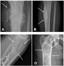 Image result for Osteosarcoma
