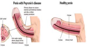 Penis Curvature Correction Bangalore Peyronie S Diseases