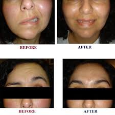 The first signs a person notices are often slurred. Bells Palsy Testimonial Agape Natural Health