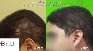 Shock hair loss is particularly frequent in women with female pattern hair loss following their hair transplant. Body Hair Transplant Repair Of Shock Loss