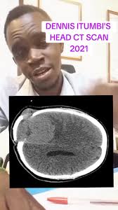 What Happened to Denis Injury