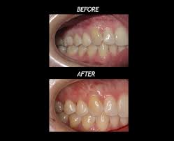 Another benefit of gum care is that it allows your child to get used to dental care in general. Gum Care Lakewood Wa Gravelly Lake Dentistry