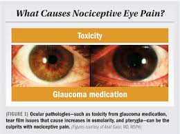 Image result for Eye Pain