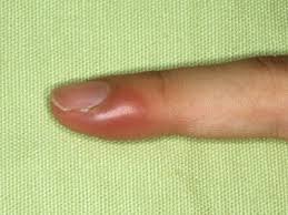 нарывает палец на ноге что делать в домашних условиях Vospalilsya Na Palce Zausenec Chem Lechit Stati Pandaland