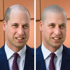 Presumably, prince william hasn't had a hair transplant because he doesn't want one. Prince William S Shaved Head Bald And Proud Skalp