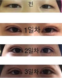 16brand / 23 years old / a.h.c / apieu / april skin / avajar / banila co / benton / briskin / claries / clio / cnp cosmetics / cosrx / double dare / dr.jart+ / elroel / etude house / g9 / heimish / holika holika / huxley / hyggee / innisfree / it's skin / jayjun / keep cool / klavuu. Selfie Asli Braun Plastic Surgery