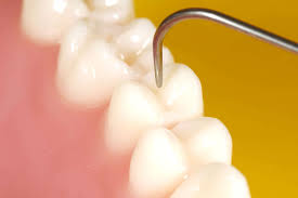 Les Caries Une Dent Contre Votre Cœur