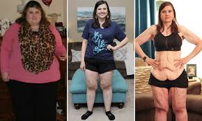 I had gastric bypass and my skin sags now. Woman Who Once Tipped Scales At 420lbs Reveals She S Waiting To Remove 20lbs Of Excess Skin Daily Mail Online