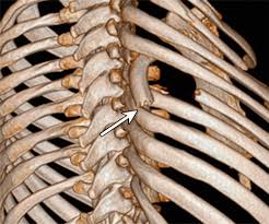 Emotions, their effect on organs & the inner smile the emotions are considered the major internal causes of disease in chinese medicine. Traumatic Rib Injury Patterns Imaging Pitfalls Complications And Treatment Radiographics