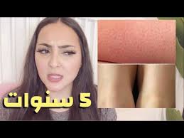بعد ٥ سنوات من ليزر ازالة الشعر الخلاااااصة وافضل عيادة في الامارات تجربتي بالتفصيل Youtube