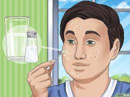 How To Get Rid Of A Zit Overnight (With Pictures) - Wikihow | Zits, Zit  Remedy, Pimples