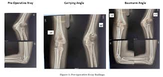 Image result for Lateral Condyle Fracture