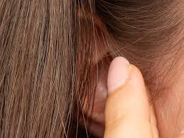 (nor do most people who recommended the practice in the first place.) all they know is that chewing gum seems to stop your ears from crackling, making for a more pleasant flight. Video Popping Blackheads Inside The Ear