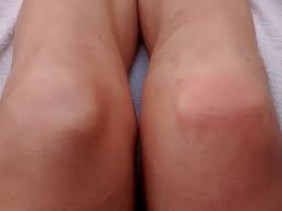 Reha Nach Meniskus Op 10 Grunde Was Deine Nachbehandlung Verzogert Knie Marathon Knie Op Reha Patienten Aufgepasst