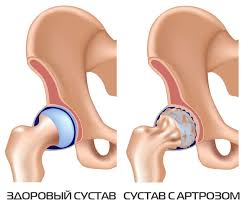 Artroz Tazobedrennogo Sustava 2 Stepeni Simptomy I Lechenie Oficialnyj Sajt Gbuz Rodilnyj Dom 2 G Magnitogorsk