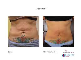 Bitter Taste In My Mouth Pregnancy Pin On Lavoro Laser S Venus Legacy Before After Pictures