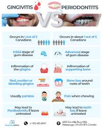 Image result for Gingivitis