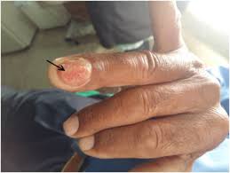Image result for Acral lentiginous melanoma nail