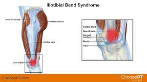 Treatment for itb friction syndrome involves reducing the pain and inflammation, identifying any underlying causes, then stretching and conditioning the hip muscle and iliotibial band. Physical Therapy Guide To Iliotibial Band Syndrome Itbs Or It Band Syndrome Choosept Com