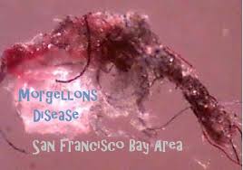 Saveli vr, leitao mm, stricker rb. Morgellons Disease San Francisco Bay Area Posts Facebook