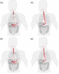 Minimally invasive mckeown esophagectomy (mie mckeown) with cervical anastomosis is a widely used approach for the treatment of esophageal cancer (ec). European Consensus On Essential Steps Of Minimally Invasive Ivor Lewis And Mckeown Esophagectomy Through Delphi Methodology Springerlink