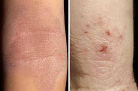 For recalcitrant eczema on the face, especially the eyelids or other sensitive skin areas. Clinical Review Atopic Eczema Gponline