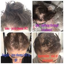 The timing of chemotherapy treatments also affects hair loss. Abvd Chemotherapy Hair Loss What Lauren Did Next
