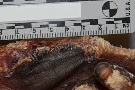 When i ask why, the answer is usually along the lines. Pathology Outlines Postmortem Changes