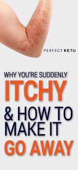 Keto Rash Why You Re Suddenly Itchy How To Make It Go Away In 2021 Keto Rash Ketogenic Diet For Beginners Keto Diet