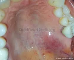 In the early stages, mouth cancer rarely causes any pain. How Can We Detect Oral Cancer Quora