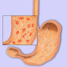 Without treatment, it can lead to complications over time. Akute Magenschleimhautentzundung