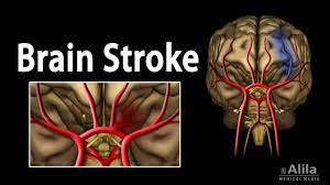 A stroke is a medical condition in which poor blood flow to the brain causes cell death. Brain Stroke Types Causes Pathology Symptoms Treatment And Prevention Video Medtube Net