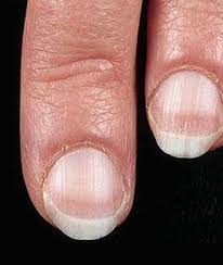 7 Things Your Nails Can Tell You About Your Health Fingernail Health Nail Health Fingernails