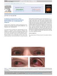 Our research showed that light sensitivity and watery eyes were also important. Pdf Unilateral Conjunctivitis As First Presentation Of Coronavirus Disease 2019 Covid 19 A Telemedicine Diagnosis